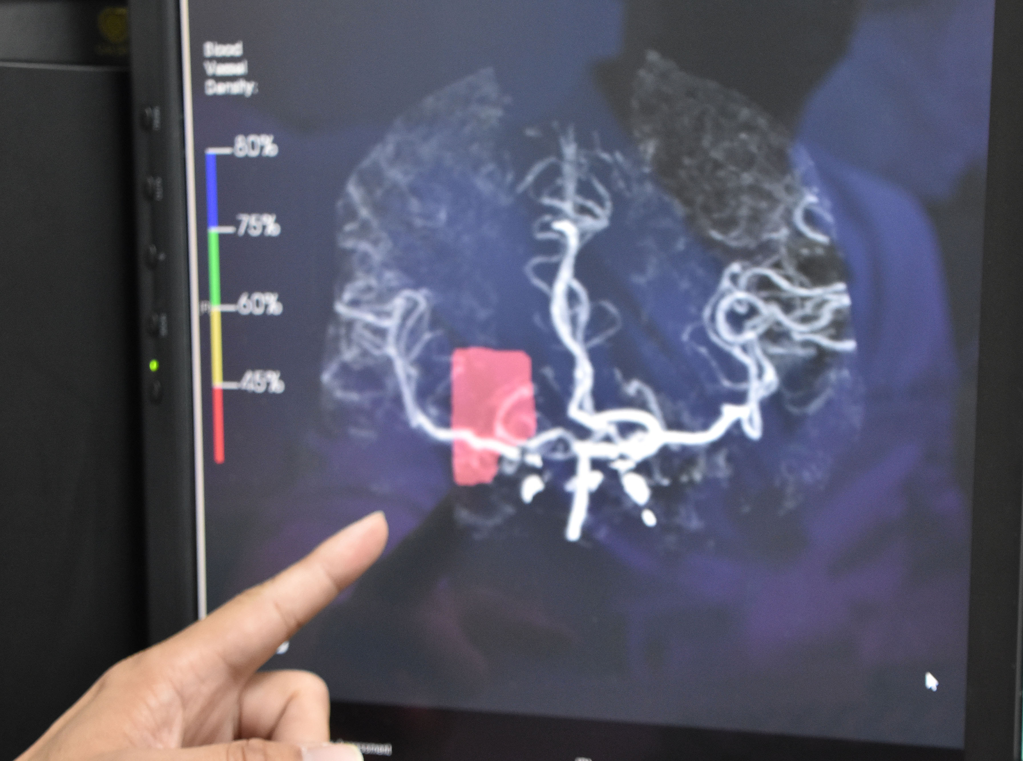 林晏任醫師手指紅色位置，為該女性病患腦部血管瘤破裂部位。(圖/彰基提供)