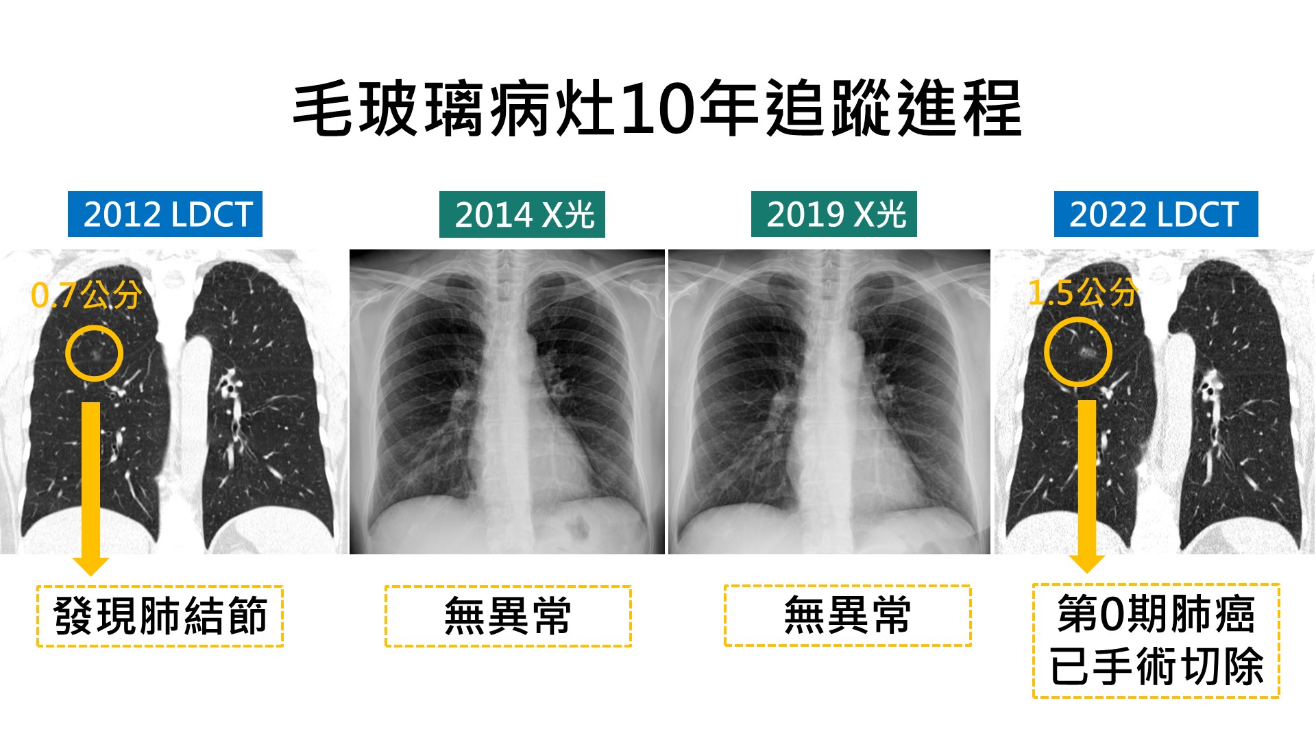 肺結節10年病灶演變肺癌進程圖示。(圖/門諾醫院提供)